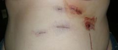 Here are my incisions as they were when i got home...ick