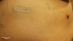 my incisions from the day of surgery...