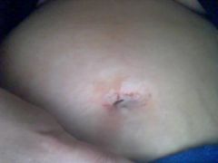 day 3, single incision