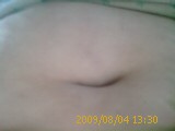 Scar 7 weeks post-op, virtually invisible..single incision