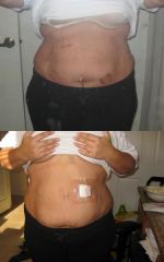 07-06-09 Oh MY FREaKIN Lord! This is from surg on bottom to 2 wks post op on top! I've lost 32 inches and this is the first time I've really seen it! I just did a little dance aroundmy bathroom, this is def enough motivation to lost until my first fill in