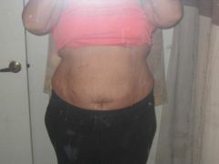 07-17-09 4 wks post op!!! down another 2 inch on waist, no lbs lost.