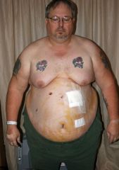 This pictures was taken the night after surgery

Day of surgery weight 359
