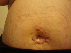 My bellybutton incision.
