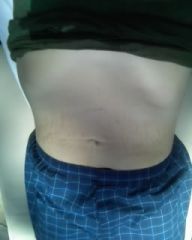 laying down...this is what my tummy should look like standing up after my tuck