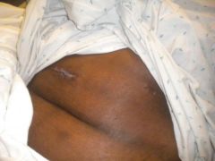 surgery scars