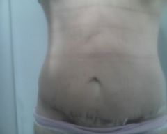 2 WEEKS AFTER PANNICULECTOMY AND MINI TUCK...STILL A LIL SWOLLEN AND YES THAT IS MY PORT STICKING OUT ON THE RIGHT SIDE