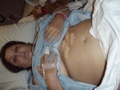Day of Surgery, December 6, 2007.