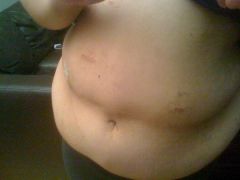 My huge belly about 2 weeks after surgery.