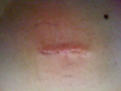 Port incision about 2 weeks after surgery.