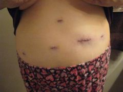 These are my incisions... this was not so bad.... 7 hrs post-op.