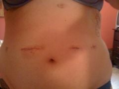 my incisions... 2 days post op
