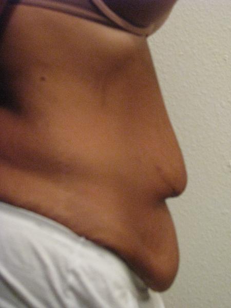 Tummy tuck (9/18/08)