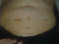 Small keyhole wounds on mi flabby belly.