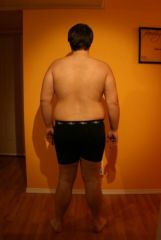 2 months post op (40 pound weigt loss - 245 pounds)(back)