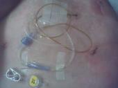 my surgery on jan 21st 2010