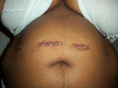 post op photo of my big abdomin and my scar.