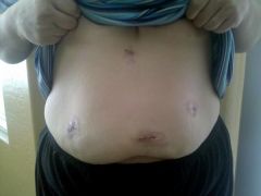 Day of Surgery, Incision sites.

3/31/10
217.4 lbs