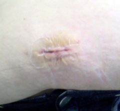 5 days POST OP - Main incision above belly button