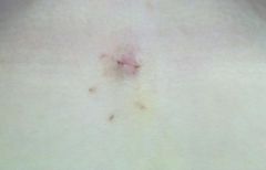 5 days POST OP - Tiny incision below & inbetween breast (where the camera & air went in)