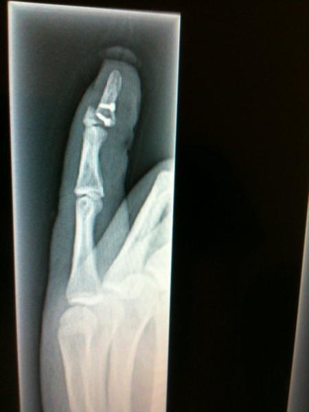 after surgery, and my finger rebreaks in my sleeps... another setback on the healing process