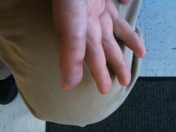 shattered, dislocated, and immobile.  my pinky is messed up!