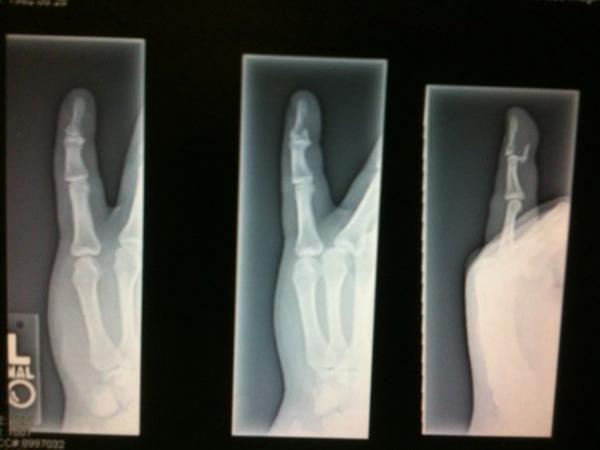more pics of my broken finger