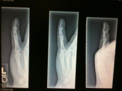 more pics of my broken finger