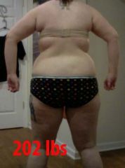 This is 15 weeks 1 day after surgery, April 24, 2010. Down 50 lbs.