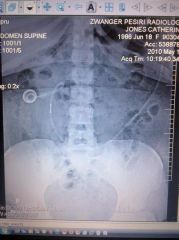 you can see my port and band very clear

for some odd reason i love how my spine looks lol