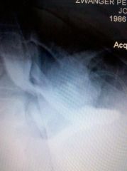close up of the band around my stomach and you can bearly see but there is the barium liquid going down to the left