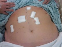 stomach after surgery
