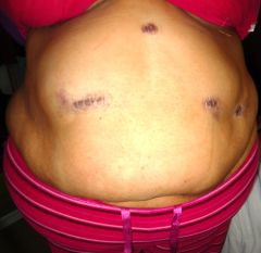 May 27, 2010 Day after surgery