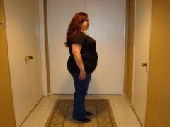 Day before surgery at 260 lbs 02/17/10