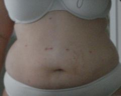 Scars 2 Months After Surgery