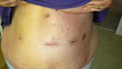 My incisions a couple days post-op