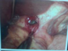 hernia repair 7 21 2010. This is a picture of my hernia before it was repaired during surgery.