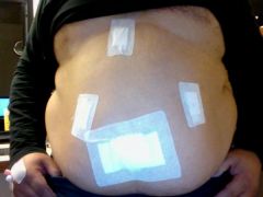 My belly button SILS port, and other little incisions