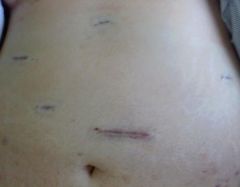 7/28/10. 5 incisions. Picture taken less then 1 hour post-op.