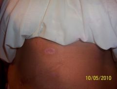 this is tummy scar's 1 day shy of a month post op. the big scar is old gallbladder scar it doesnt count lol
