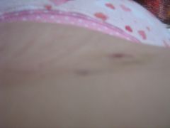The day of my surgery May2/2011