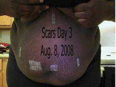 Scars Day 3