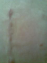 my port incision, also with me lying on my side when i took it, also a week post op