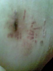 my high up incision, i ws lying on my side when i took it, this is a week post op