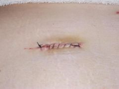 incisions 2 days post op (1)