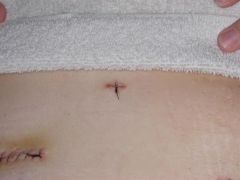 incisions 2 days post op (2)
