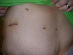 incisions 5 days post op