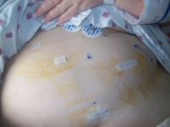 MY TUMMY AFTER SURGERY
