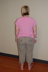 I can't believe I am posting this pic. But hopefully my back-end will NEVER look like that again. Post-op Day 1: 5-28-08.