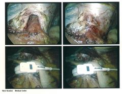 Surgery Pic of Lapband and Hernia